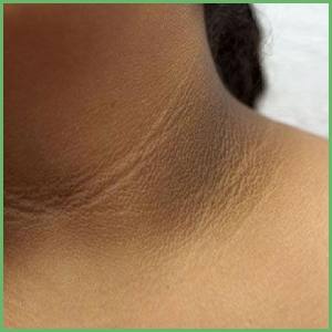 Dark neck lines cause